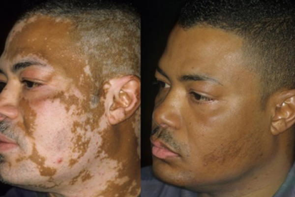 Vitiligo